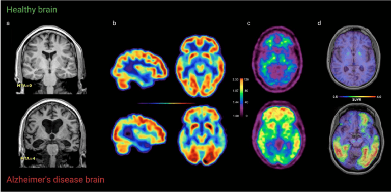 Alzheimer : des chercheurs découvrent un nouveau déclencheur de la maladie et un composé capable de l'arrêter.